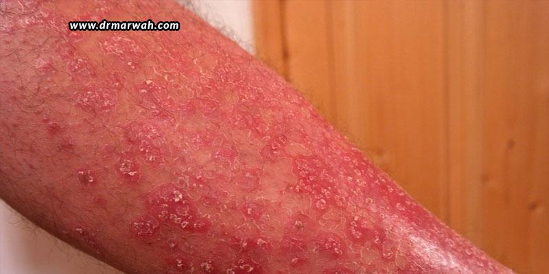 Psoriasis Symptoms Causes And Treatments Dr Marwahs Clinic